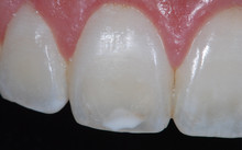 前歯のホワイトスポット修復『アイコン』1
