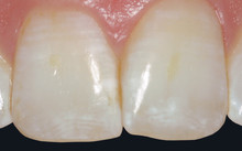 前歯のホワイトスポット修復『アイコン』3